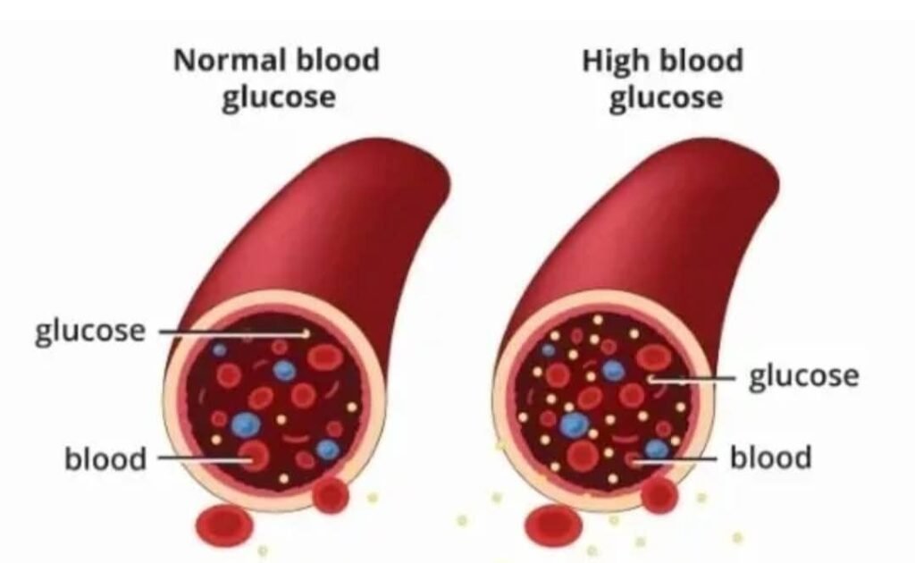 Diabetes Herbal Medication – Blood Sugar Support