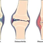 Arthritis & Joint Herbal Medication – Mobility Support 1