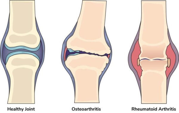 Arthritis & Joint