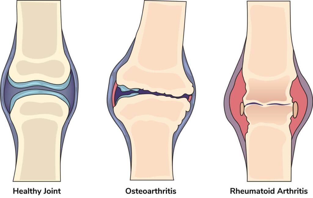 Arthritis & Joint Herbal Medication – Mobility Support