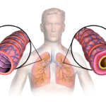 Asthma & Respiratory Herbal Medication – Respiratory Support 1