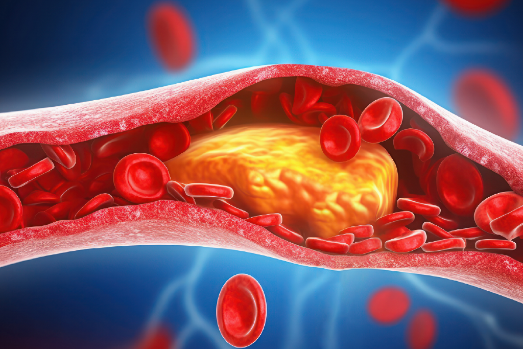 High Cholesterol Herbal Medication – Heart Support